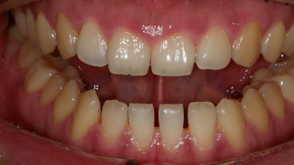 입 벌리고 있는 치과 환자