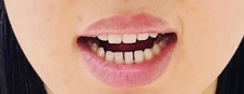 입 벌리고 있는 여성 환자분