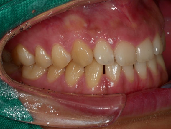 입 벌리고 있는 치과 환자