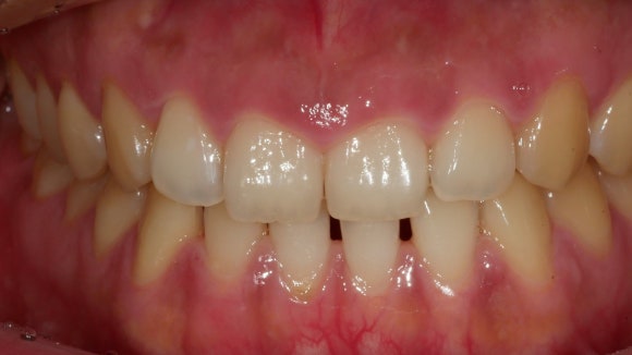 입 벌리고 있는 치과 환자