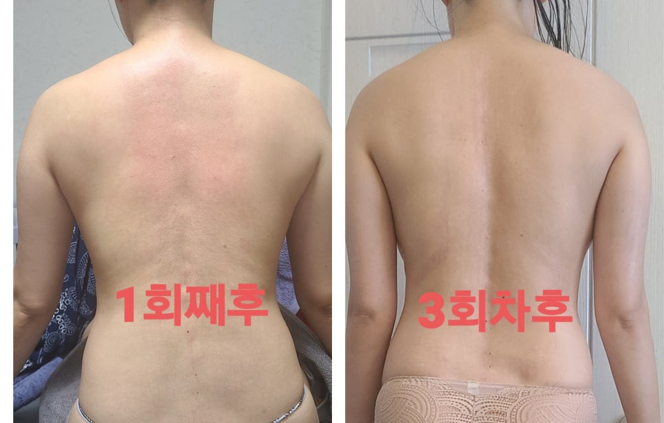 리치테라피 이미지