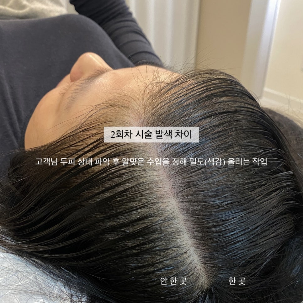 탈모왕수원 이미지