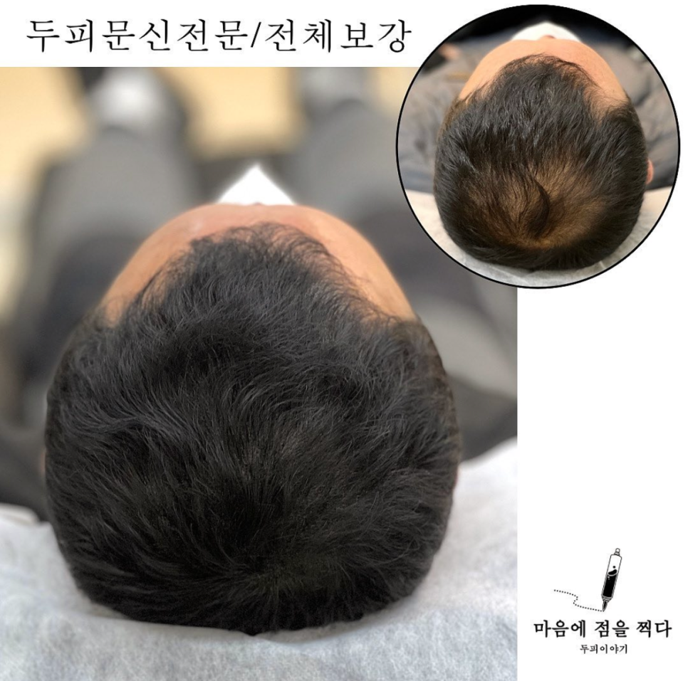 마음에점을찍다두피SMP 이미지