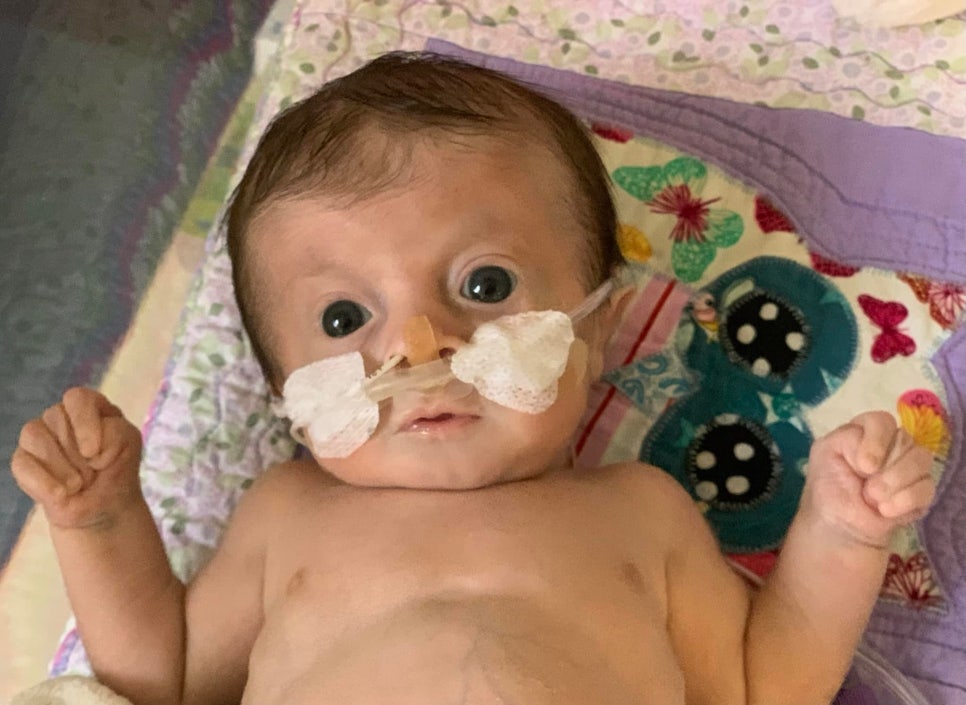 Edwards Syndrome edwards-syndrome