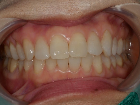 라미네이트 전 치아 사진