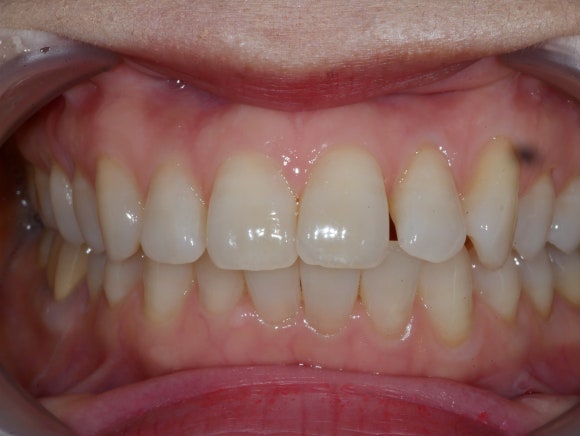 라미네이트 전 치아 사진