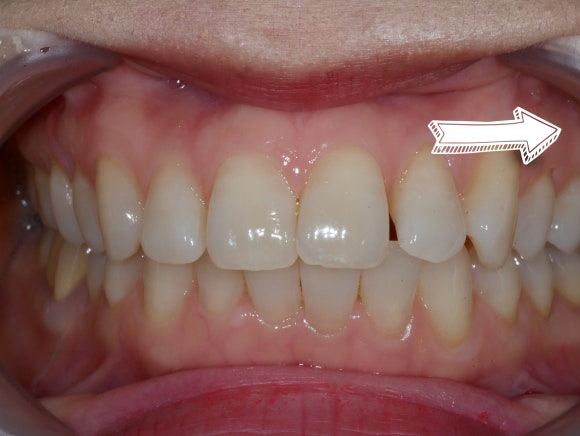 라미네이트 전 치아사진