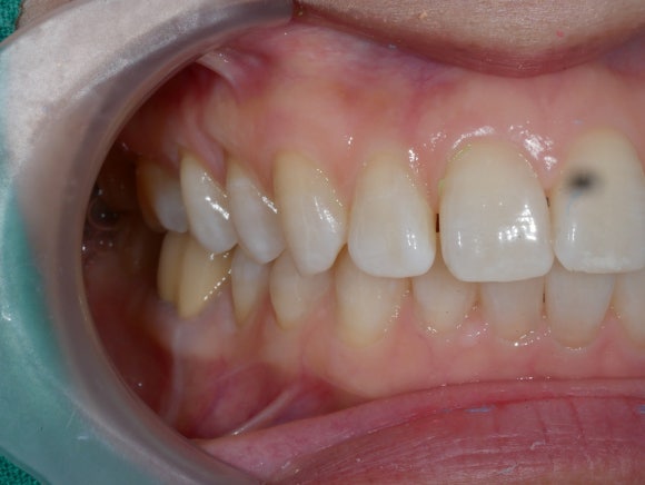 라미네이트 전 치아사진