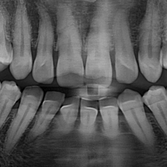 라미네이트 전 엑진
