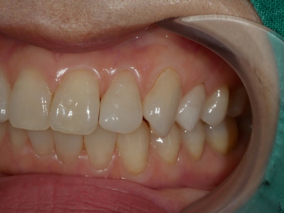 라미네이트 후 치아 사진