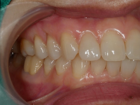라미네이트 후 치아 사진