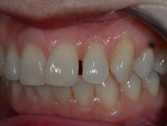 라미네이트 전 치아사진