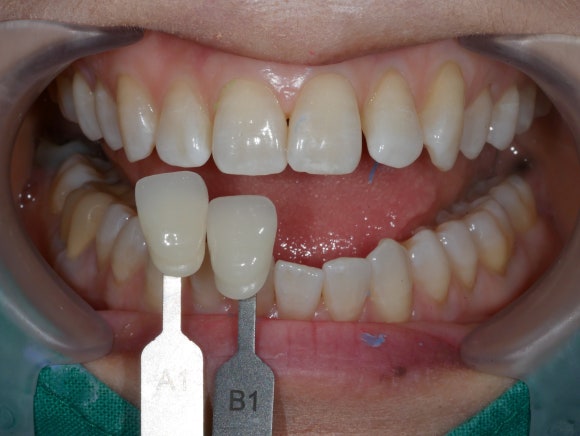 라미네이트 본뜨기 전 치아 색상 비교진