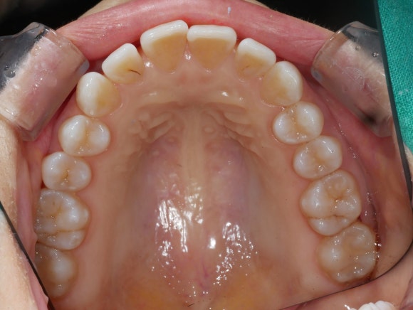 라미네이트 전 치아 교합면진