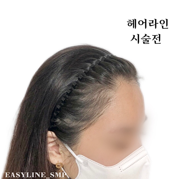 이지헤어라인 이미지