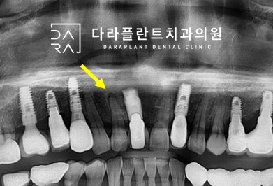 본레져 이미지