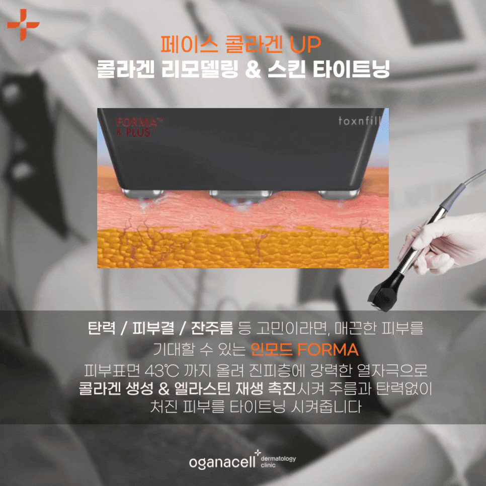 청담 인모드FX V라인완성 통증은? 관련 이미지 7