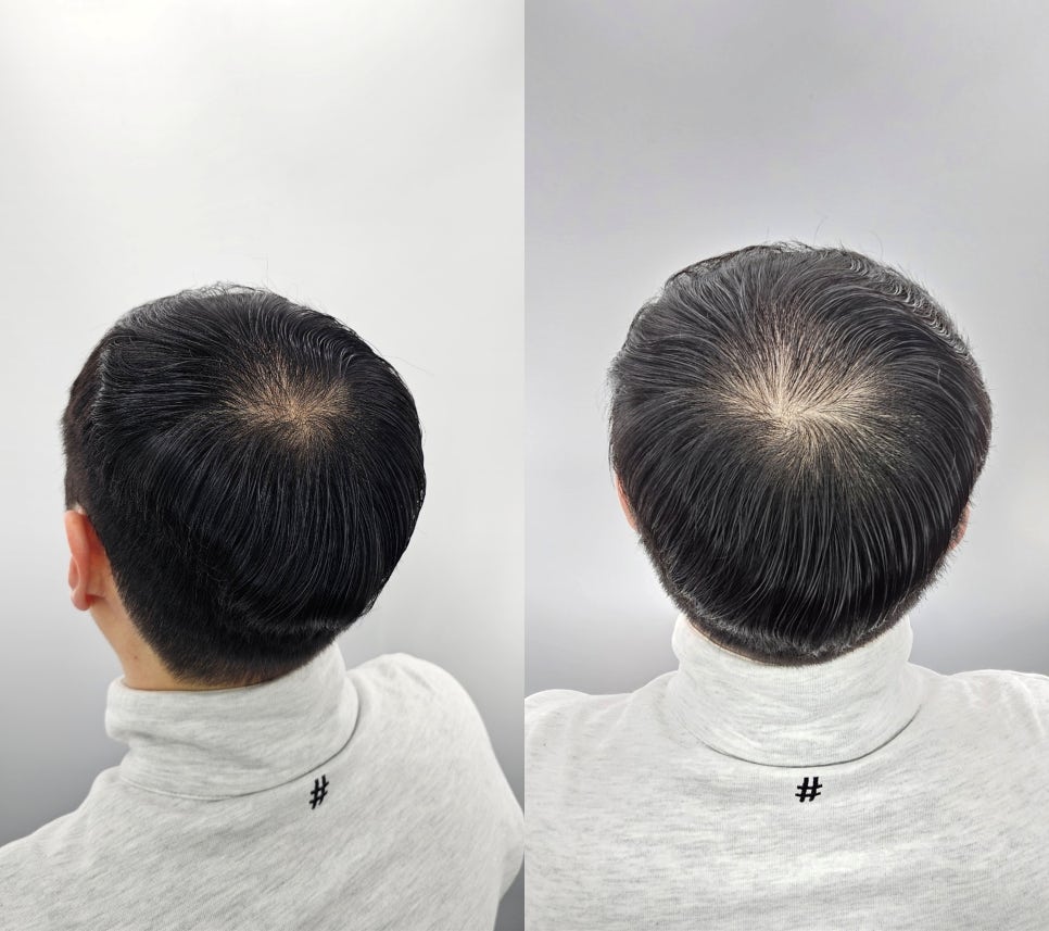 헤드샷스칼프SMP부산 이미지