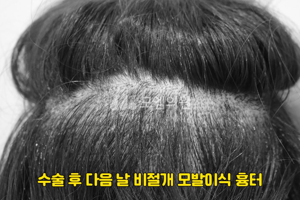 중앙헤어라인 이미지