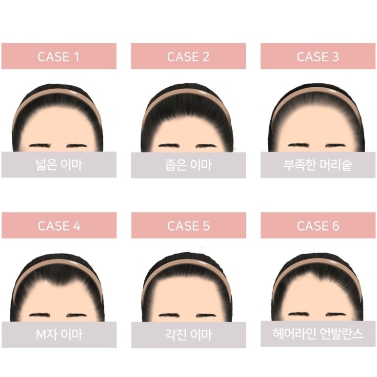 초이스칼프 이미지