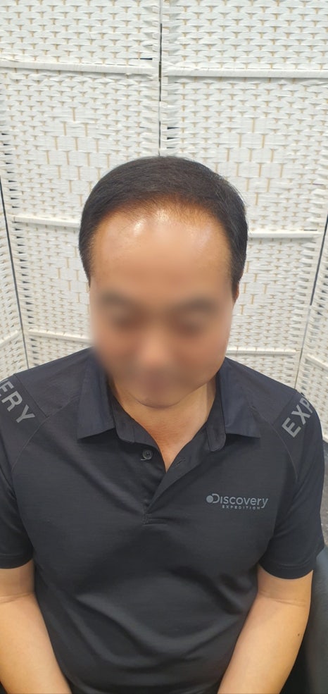 김호증모가발by헤어리서치 이미지