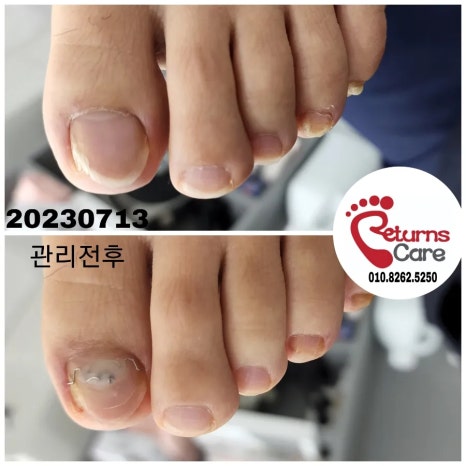 페도솔루션 이미지