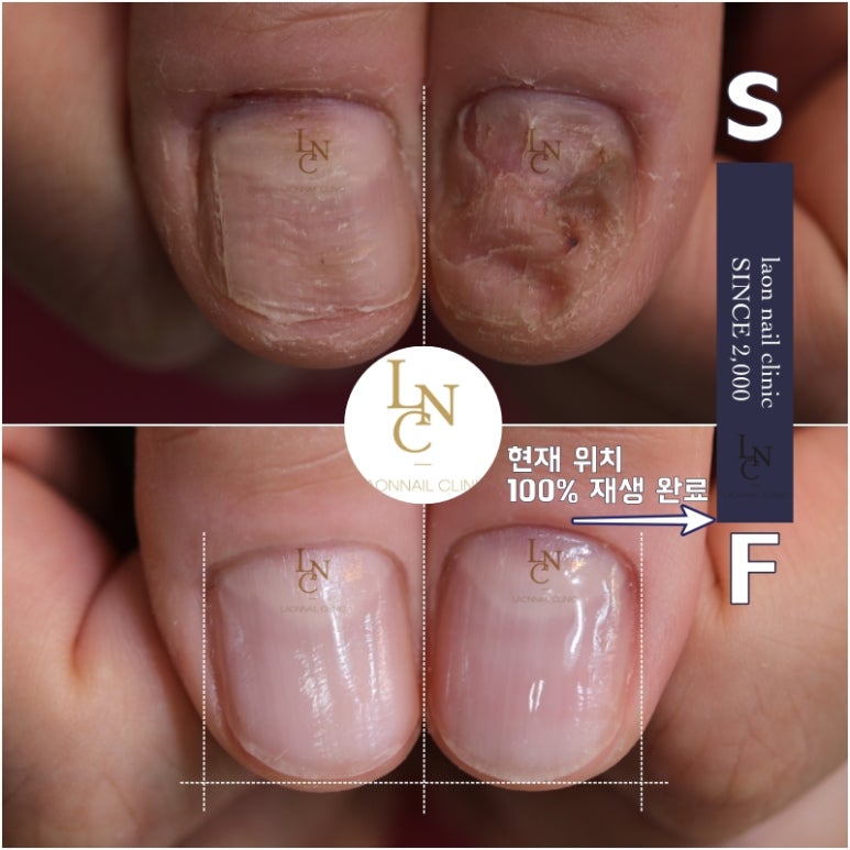 Nail ONE 이미지