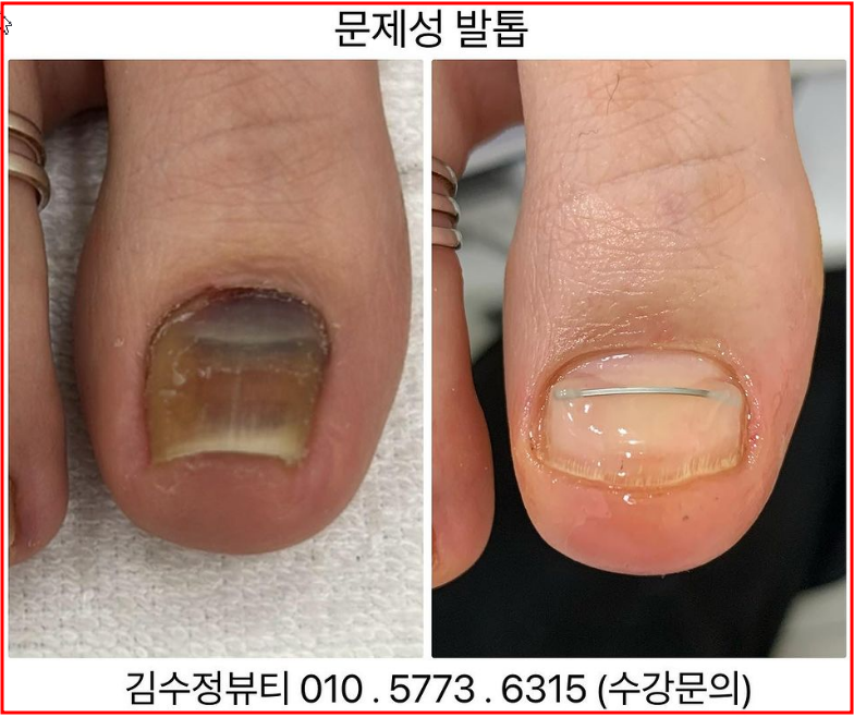 내성발톱발톱무좀관리김수정뷰티 이미지