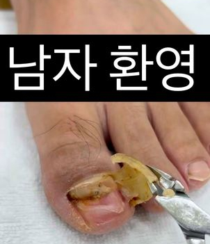 내성발톱발톱무좀관리김수정뷰티 이미지