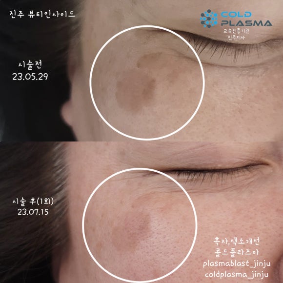 콜드플라즈마 이미지