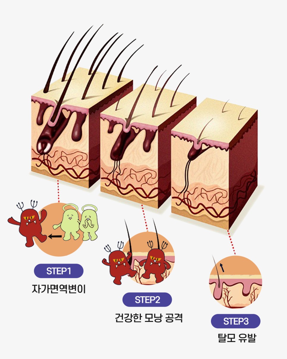 이안두피탈모 이미지