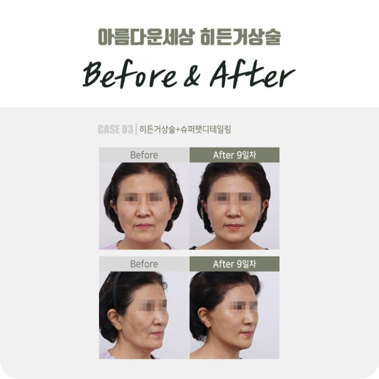 안면슈퍼 이미지