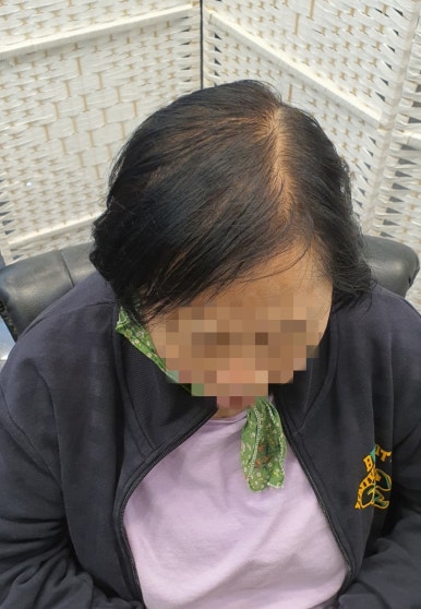 김호증모가발by헤어리서치 이미지
