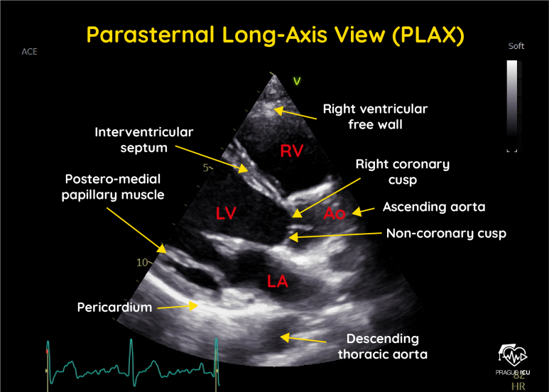 심초음파(TTE) : I. Parasternal long axis view (PSLA, PLAV, PLAX) : 네이버 블로그