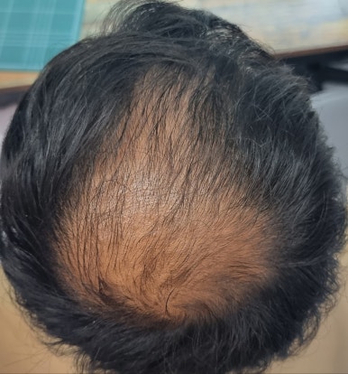 까망채움스칼프 이미지