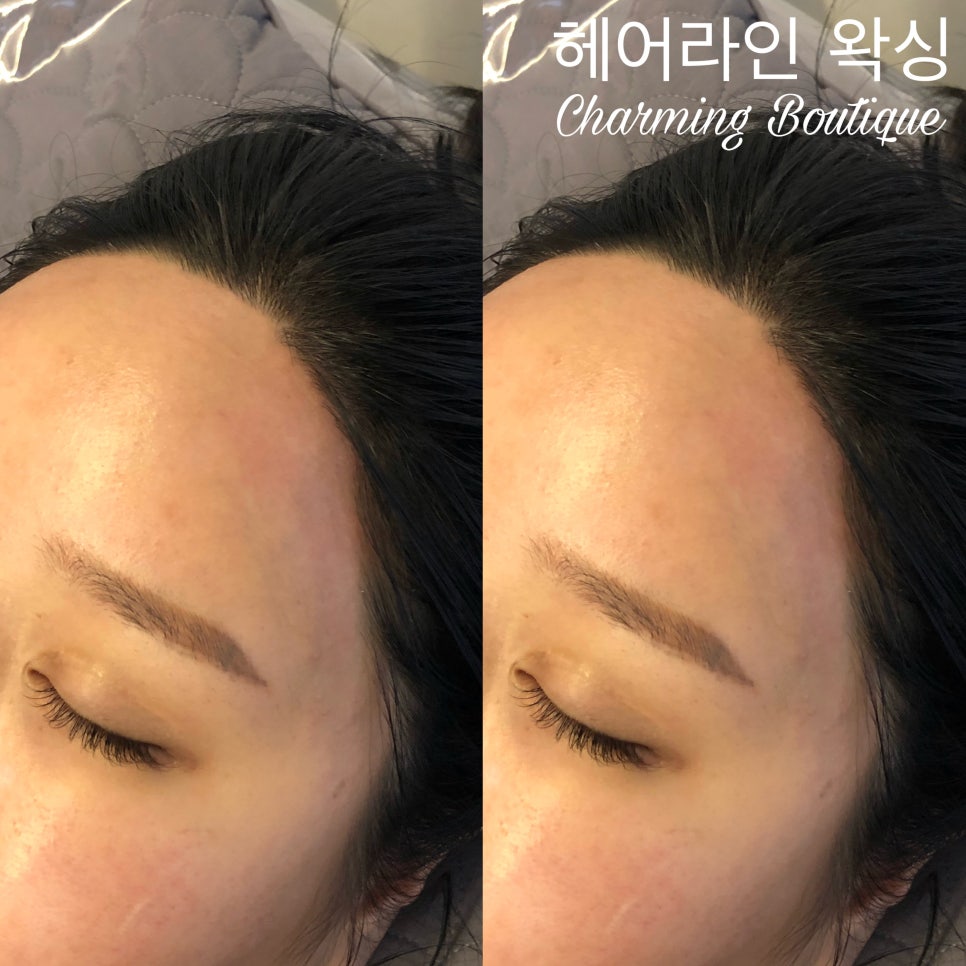 챠밍헤어라인 이미지