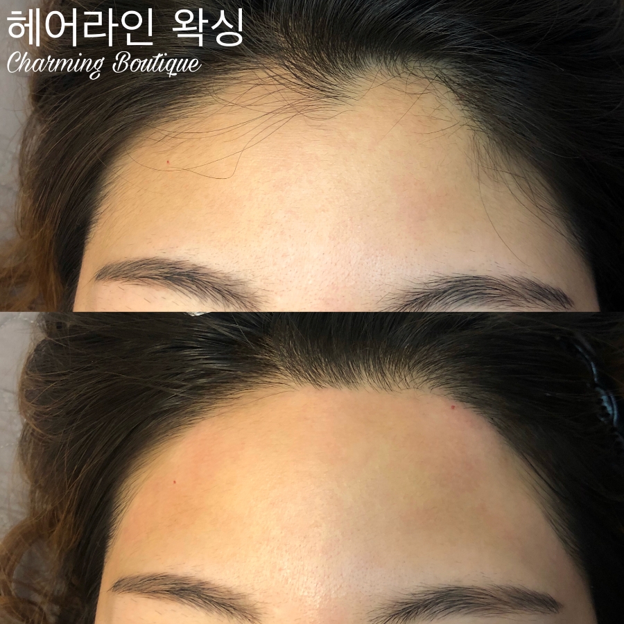 챠밍헤어라인 이미지