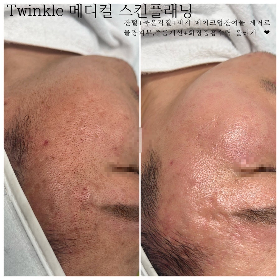트윙클왁싱 이미지