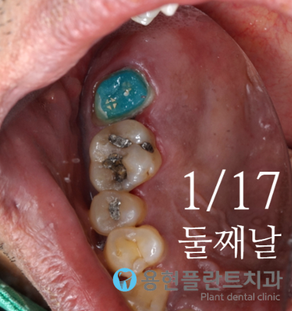 플란트열 이미지