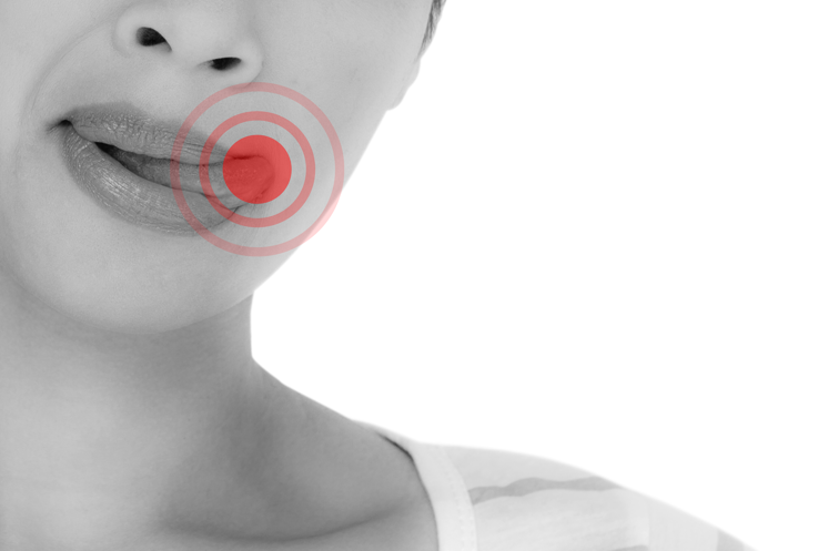 조기 치료가 중요한 설암, 설암 초기 증상과 설암 원인은? : 네이버 블로그