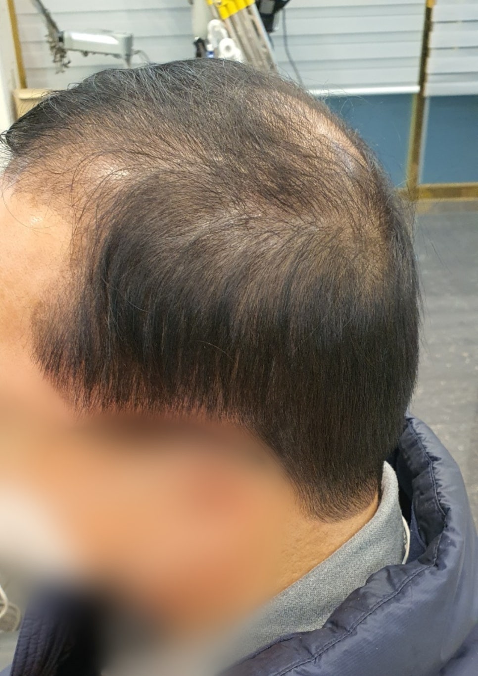 김호증모가발by헤어리서치 이미지