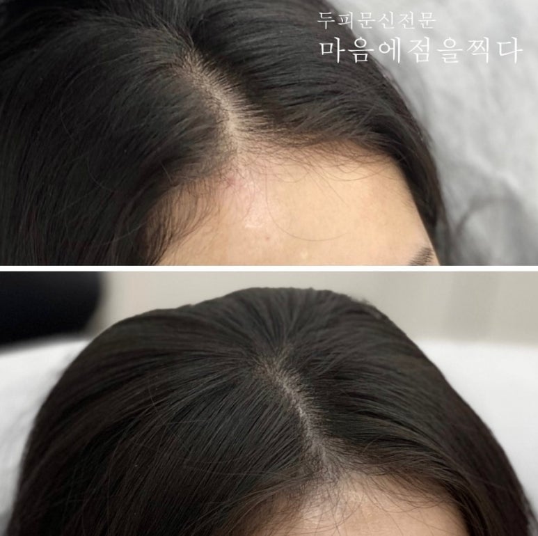마음에점을찍다두피SMP 이미지