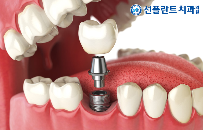 우리플란트치과의원 이미지