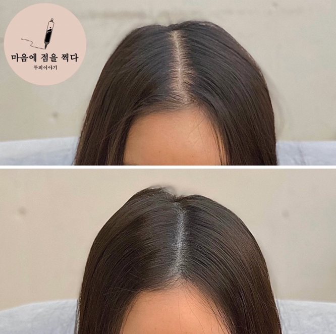 마음에점을찍다두피SMP 이미지