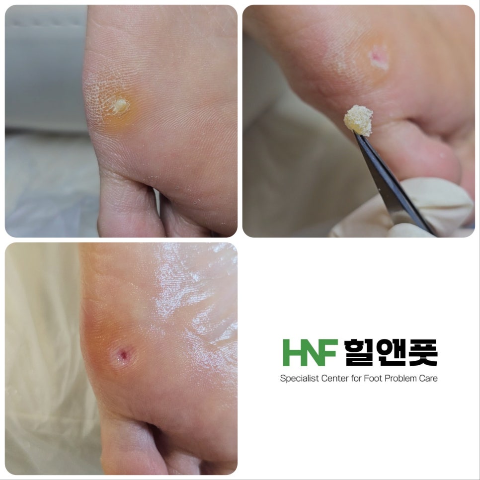 힐앤풋 이미지