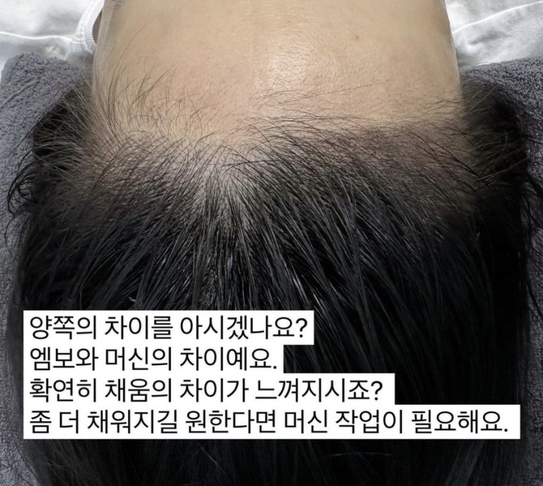오즈헤어라인 이미지