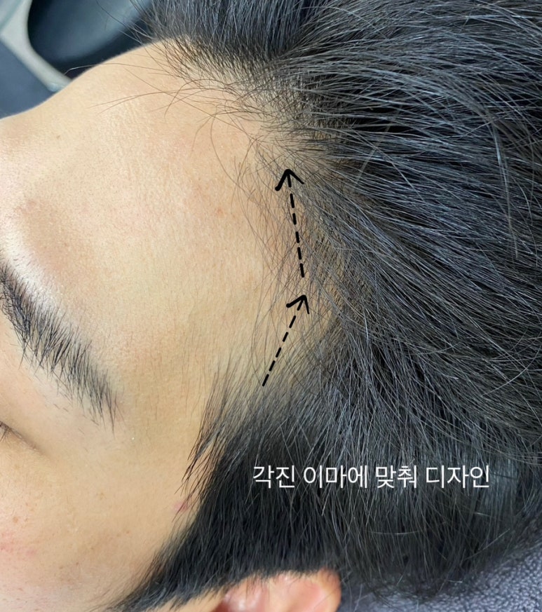 오즈헤어라인 이미지