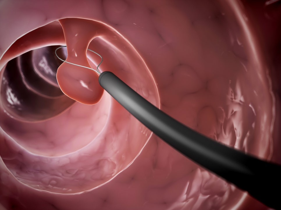 대장내시경 전날 음식 어떻게 먹어야 할까? : 네이버 블로그