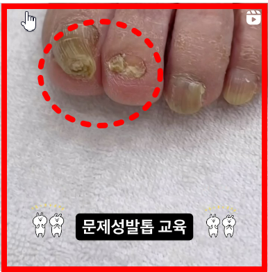 내성발톱발톱무좀관리김수정뷰티 이미지