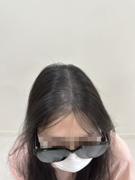 두피움 이미지